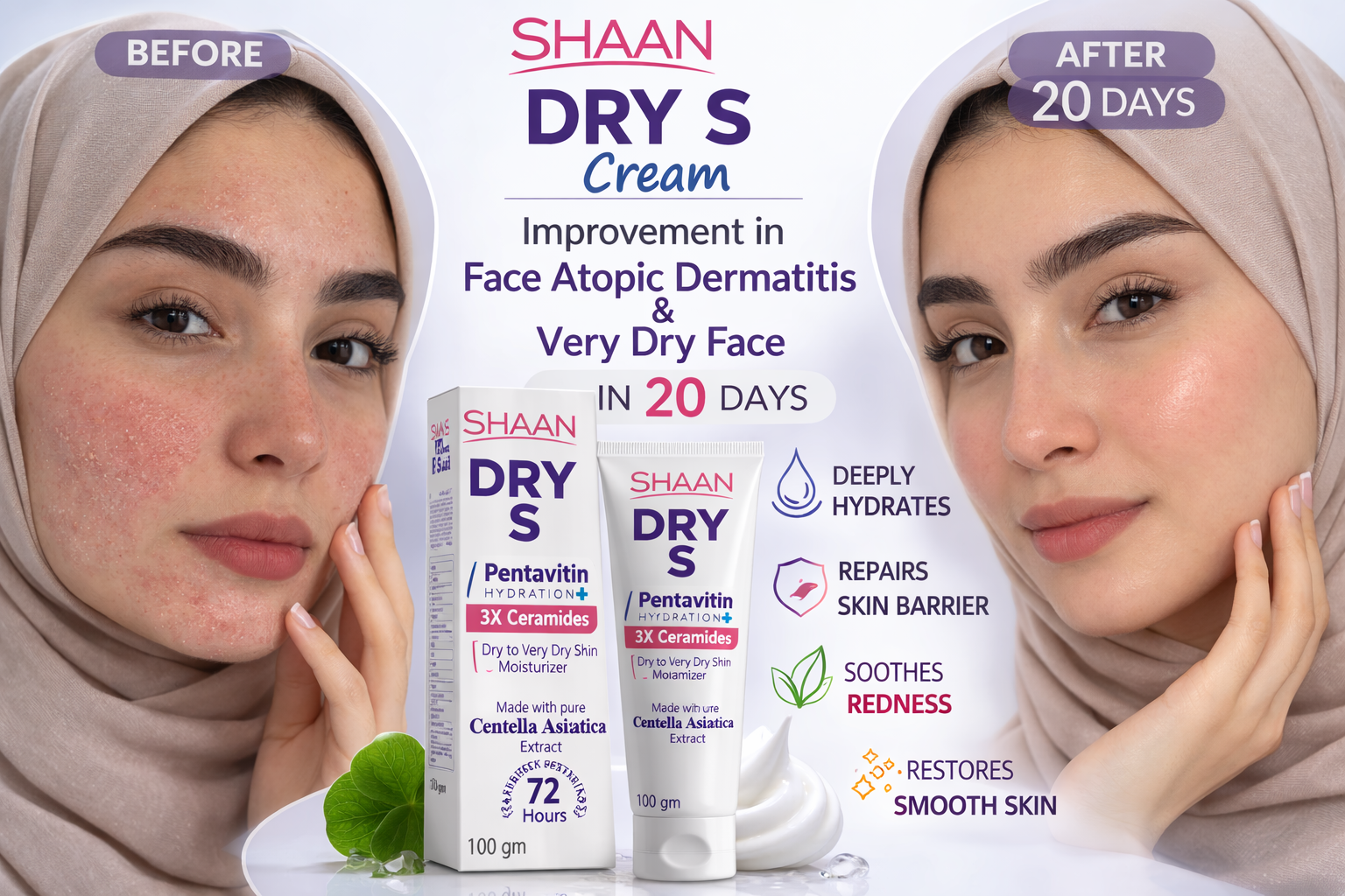 Before and after comparison of a woman's face with shaan Dry S Cream packaging and text highlighting product benefits.