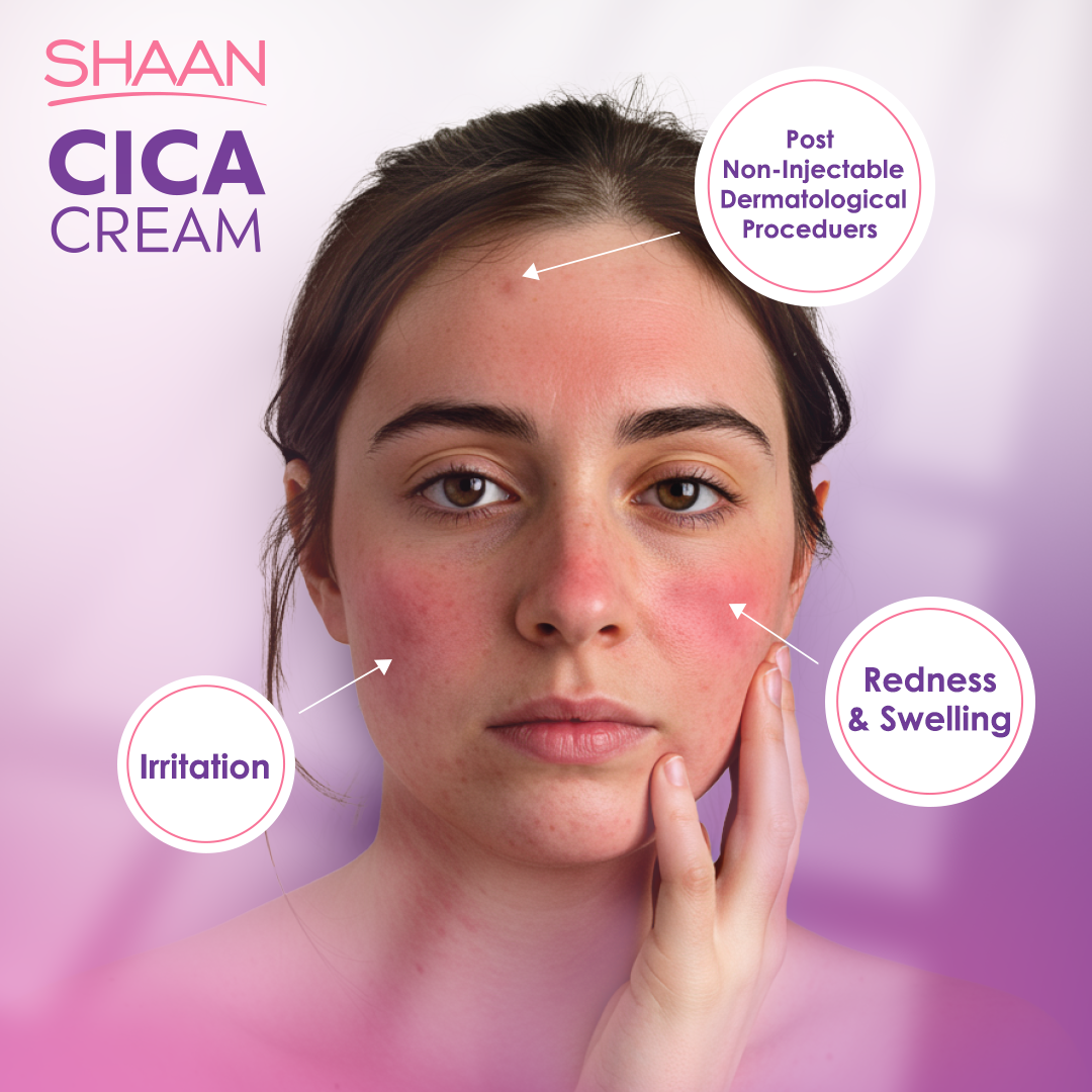 Woman with redness and swelling on her face, indicating the effects of non-injectable dermatological procedures, with 'Shaan CICA Cream'.