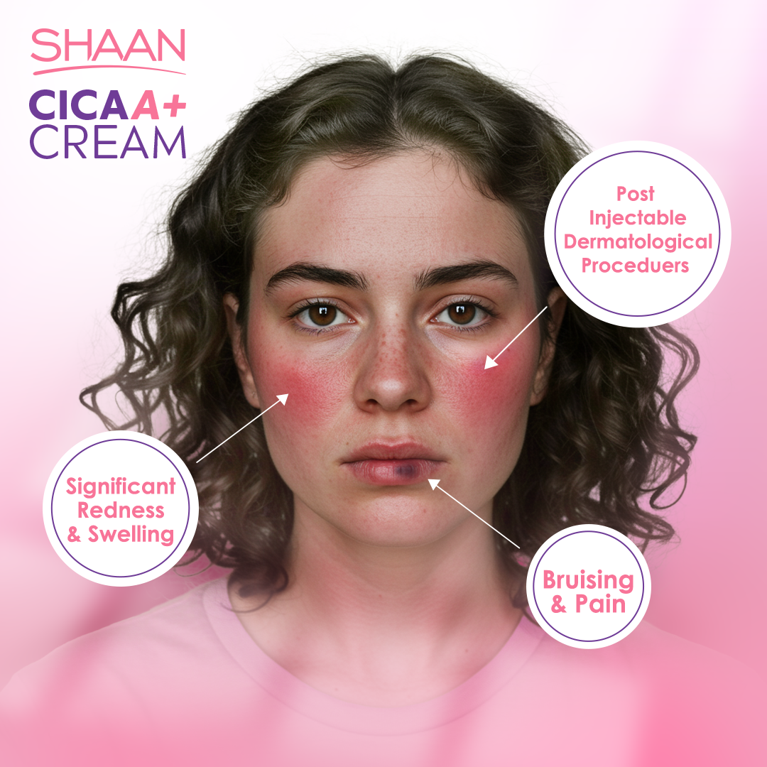 Advertisement for Shaan CICA+ Cream showing a woman's face with redness and swelling, labeled as post-injectable dermatological procedures.