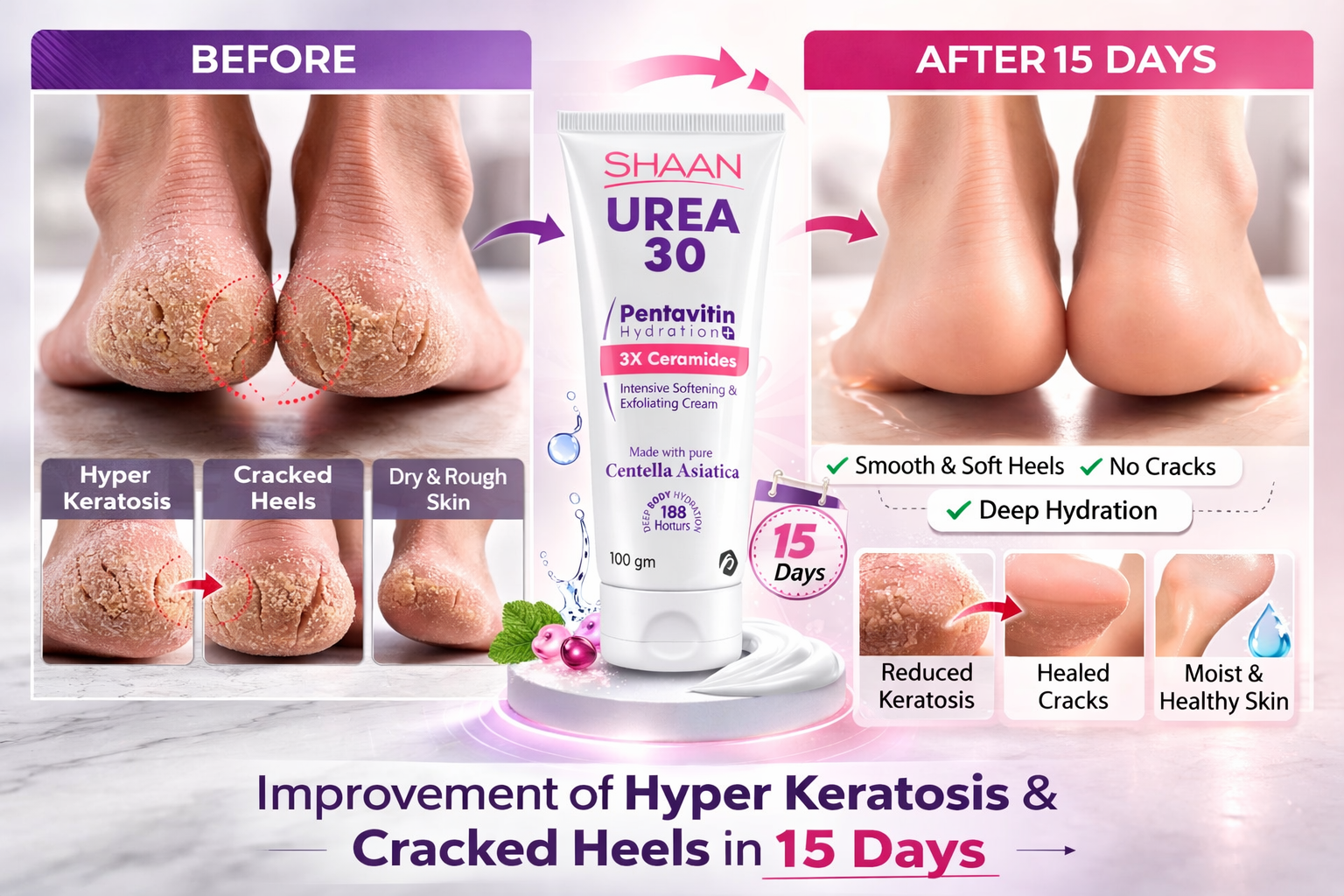 Before and after comparison of feet using a shaan urea 30 cream with visible improvement.